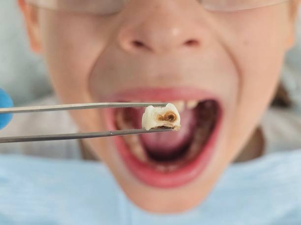 Best Emergency Root Canal Therapy in Wendell, NC